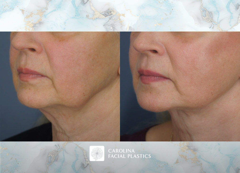 Carolina Facial Plastics - Facelift, Bilateral Lower Blepharoplasty, Endoscopic Brow Lift, and Fat Grafting to Lower Eyes and Chin by Dr Jonathan Kulbersh