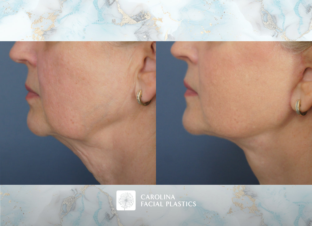 Carolina Facial Plastics - Facelift, Bilateral Lower Blepharoplasty, Endoscopic Brow Lift, and Fat Grafting to Lower Eyes and Chin by Dr Jonathan Kulbersh