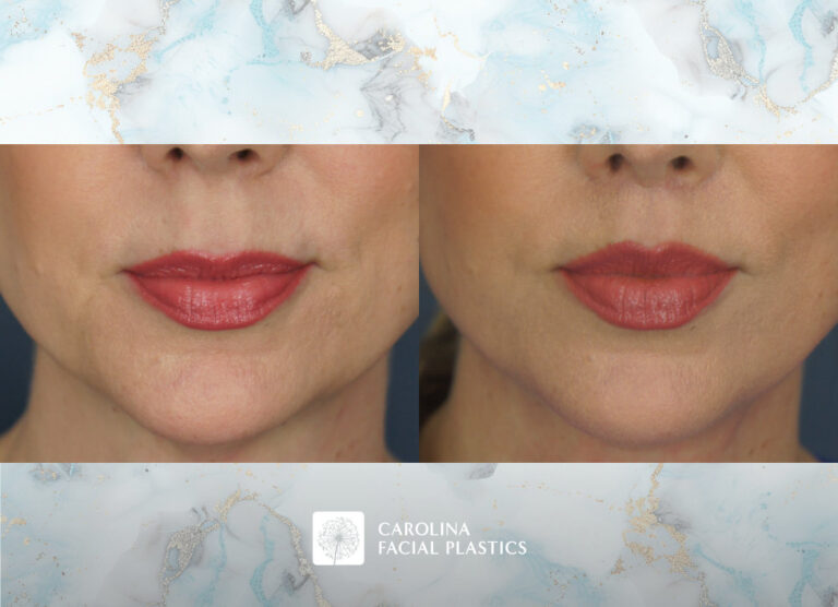 Carolina Facial Plastics - Lip Lift by Dr. Jonathan Kulbersh