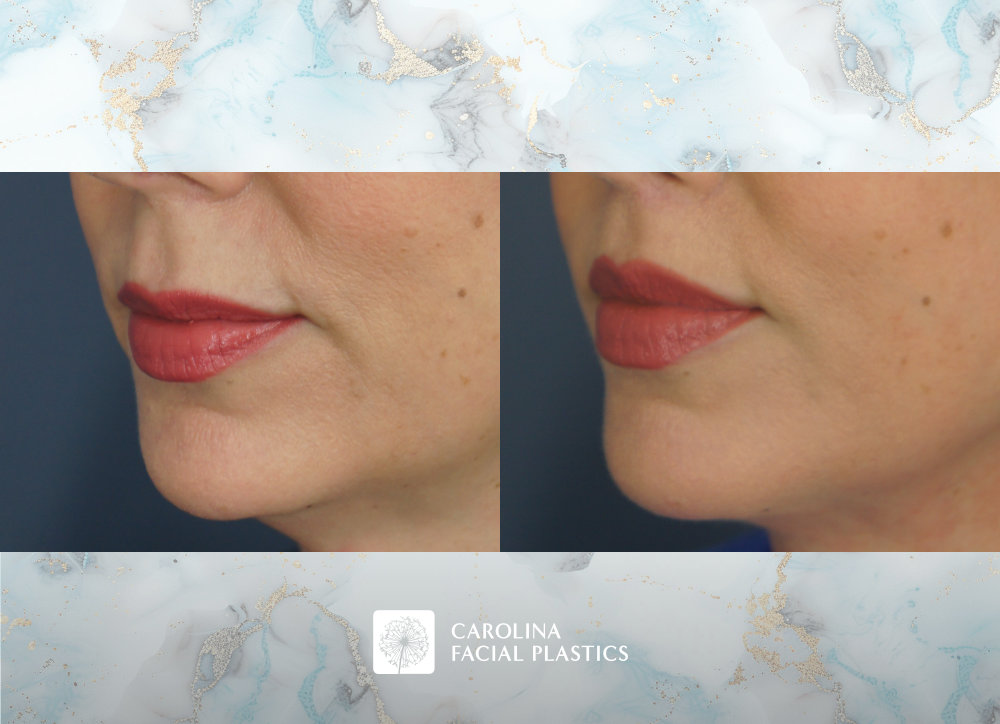 Carolina Facial Plastics - Lip Lift by Dr. Jonathan Kulbersh