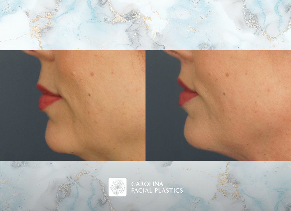 Carolina Facial Plastics - Lip Lift by Dr. Jonathan Kulbersh
