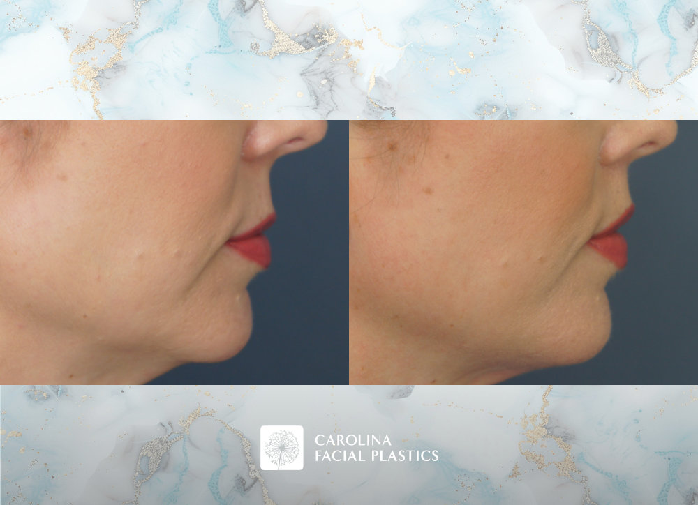 Carolina Facial Plastics - Lip Lift by Dr. Jonathan Kulbersh