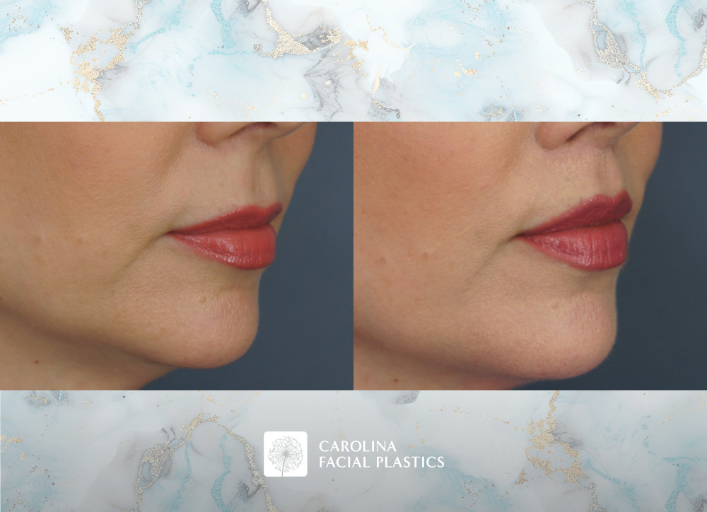 Carolina Facial Plastics - Lip Lift by Dr. Jonathan Kulbersh