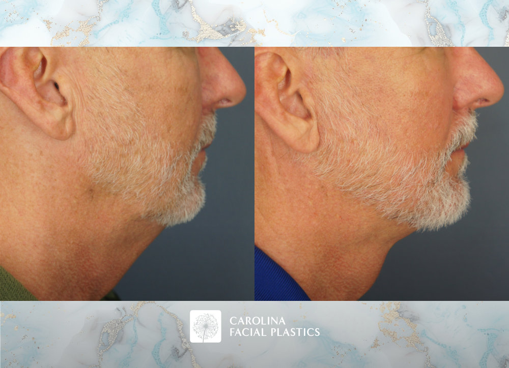 Carolina Facial Plastics - Vertical Deep Plane Lower Facelift, Neck Lift, and Platysmaplasty by Dr Jonathan Kulbersh