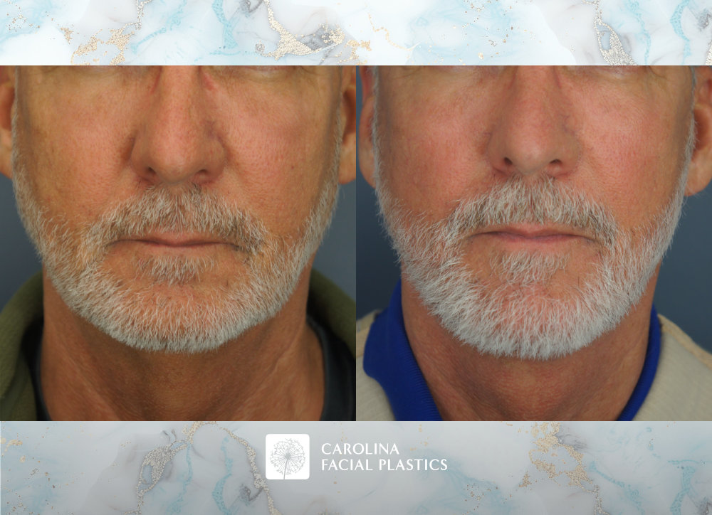 Carolina Facial Plastics - Vertical Deep Plane Lower Facelift, Neck Lift, and Platysmaplasty by Dr Jonathan Kulbersh