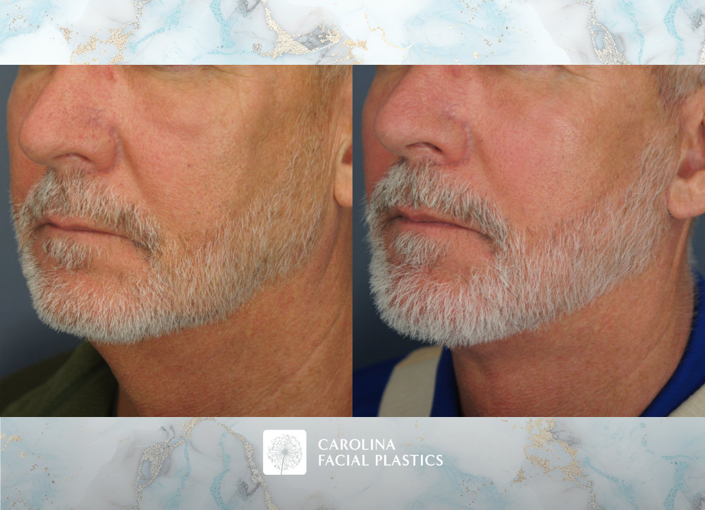 Carolina Facial Plastics - Vertical Deep Plane Lower Facelift, Neck Lift, and Platysmaplasty by Dr Jonathan Kulbersh