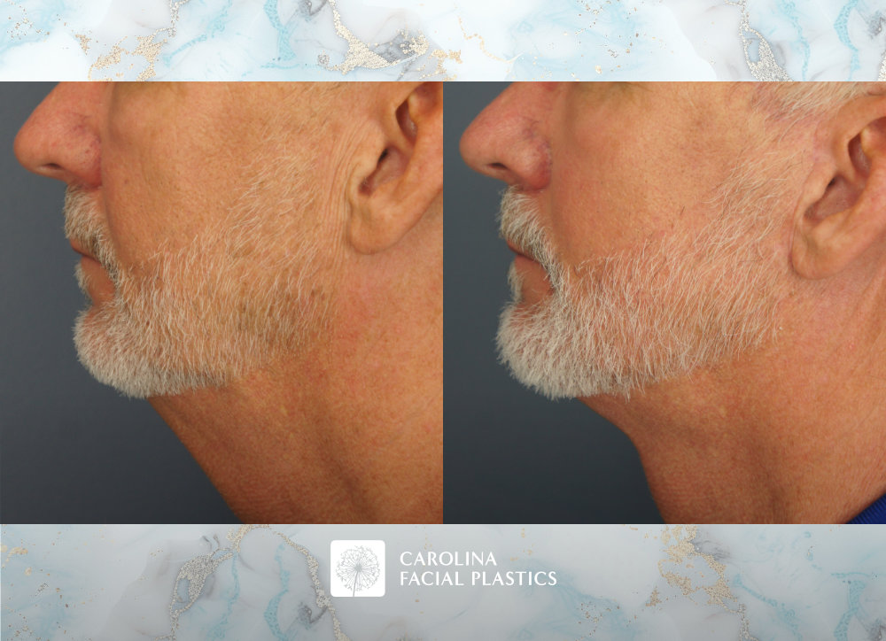 Carolina Facial Plastics - Vertical Deep Plane Lower Facelift, Neck Lift, and Platysmaplasty by Dr Jonathan Kulbersh