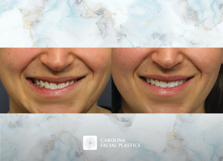 Botox for asymmetry before and after photos