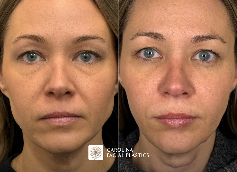 before and after photos for Botox to DAOs, chin, masseters, upper face. Filler in the cheeks, lips, jawline, lower face