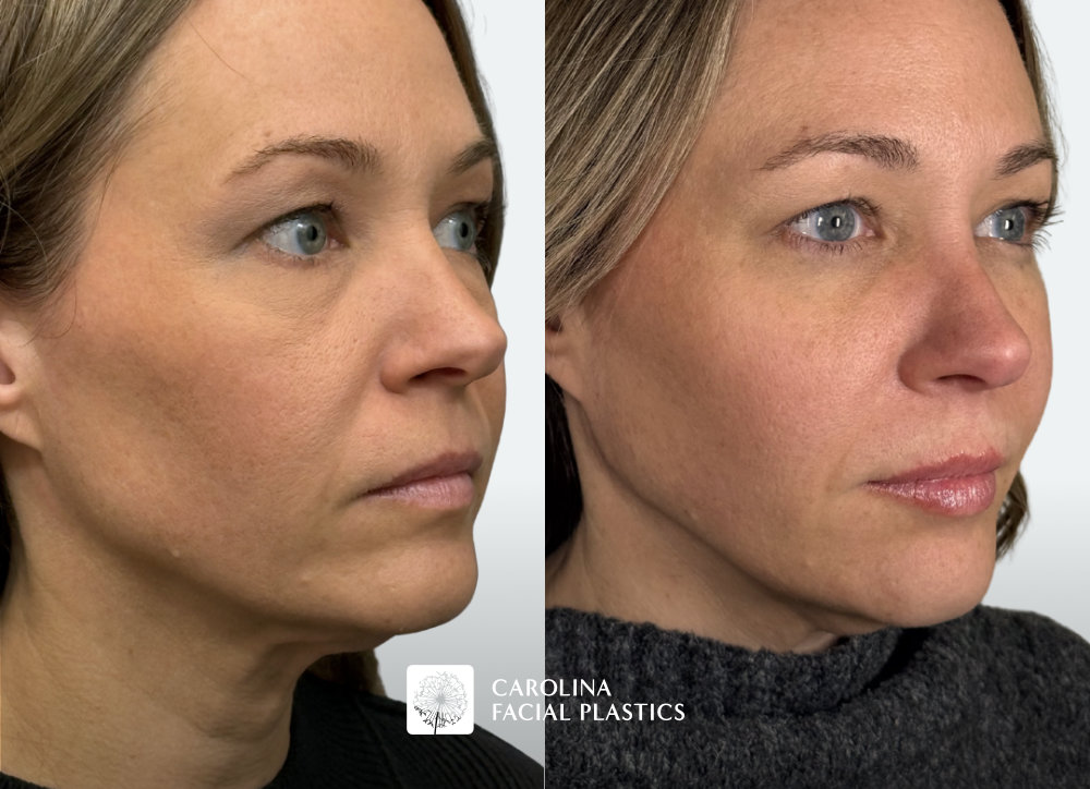 before and after photos for Botox to DAOs, chin, masseters, upper face. Filler in the cheeks, lips, jawline, lower face