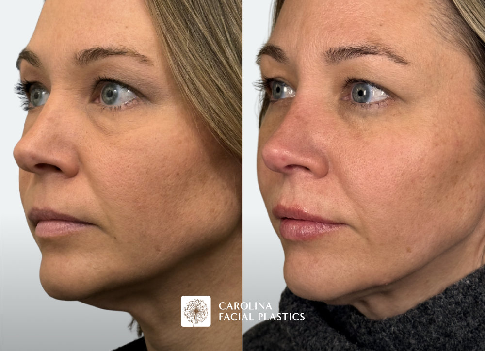 before and after photos for Botox to DAOs, chin, masseters, upper face. Filler in the cheeks, lips, jawline, lower face