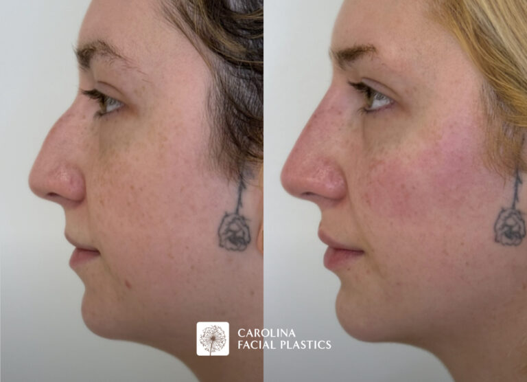 Filler in the cheek, lip, chin and nose before and after photos