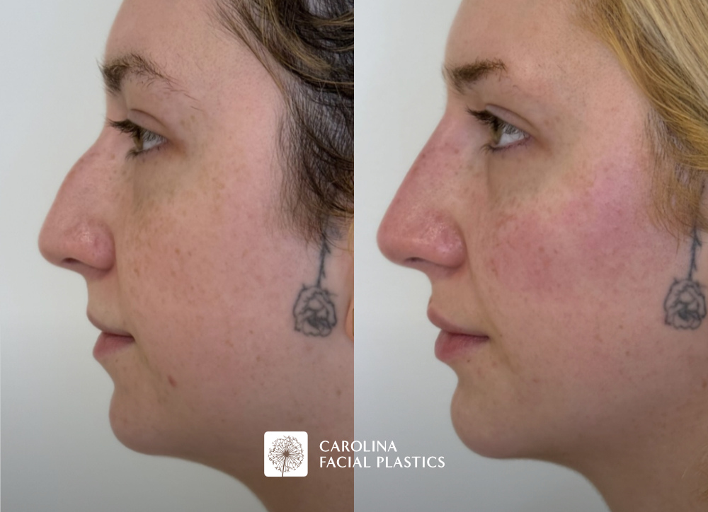 Filler in the cheek, lip, chin and nose before and after photos