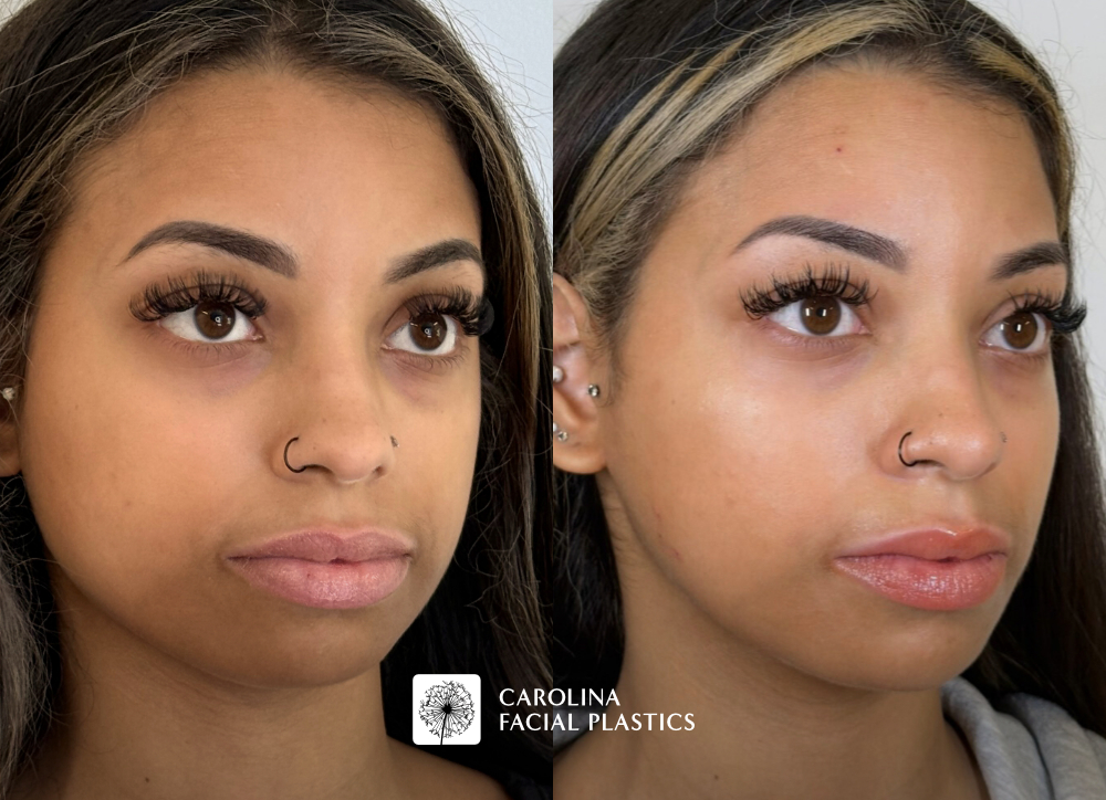 Before and after photos of Filler in the nose, cheek, chin and Masseter Botox
