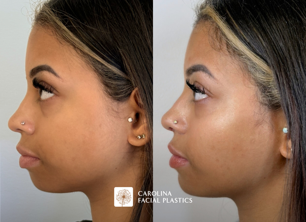 Before and after photos of Filler in the nose, cheek, chin and Masseter Botox