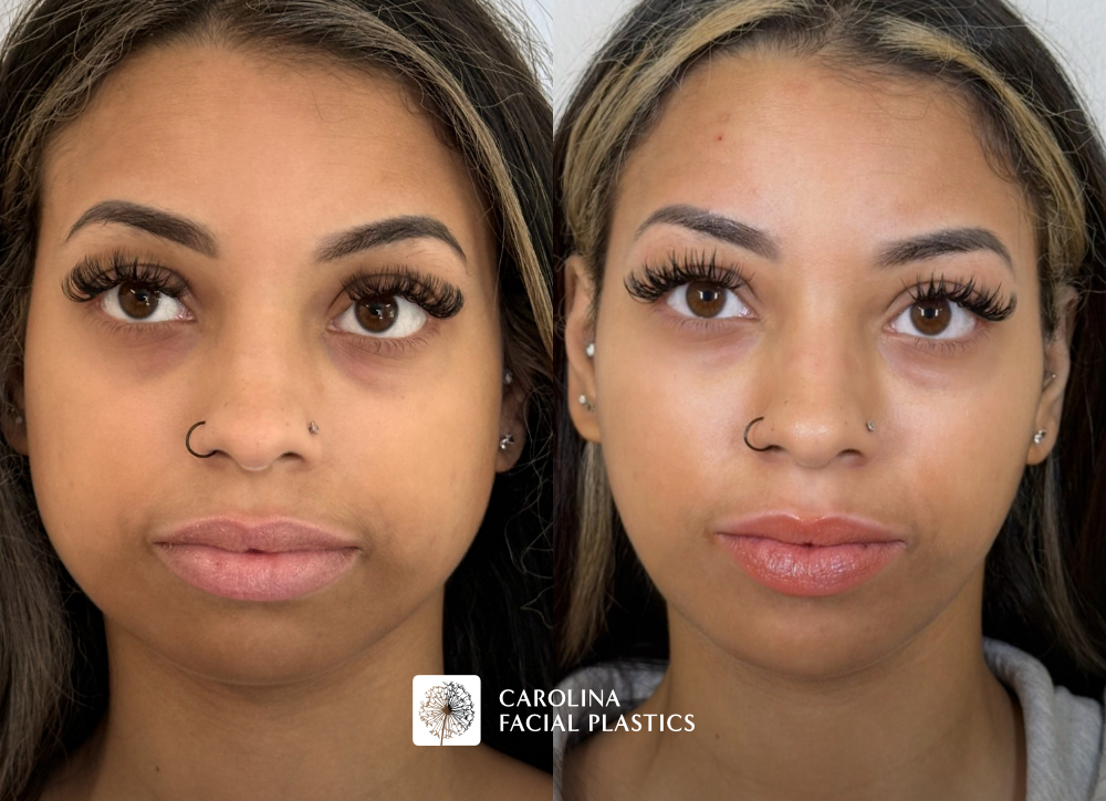 Before and after photos of Filler in the nose, cheek, chin and Masseter Botox