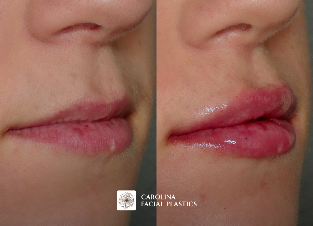 Lip filler before and after photos