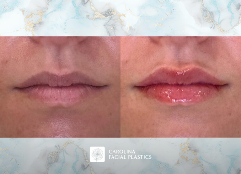 Lip filler before and after photos