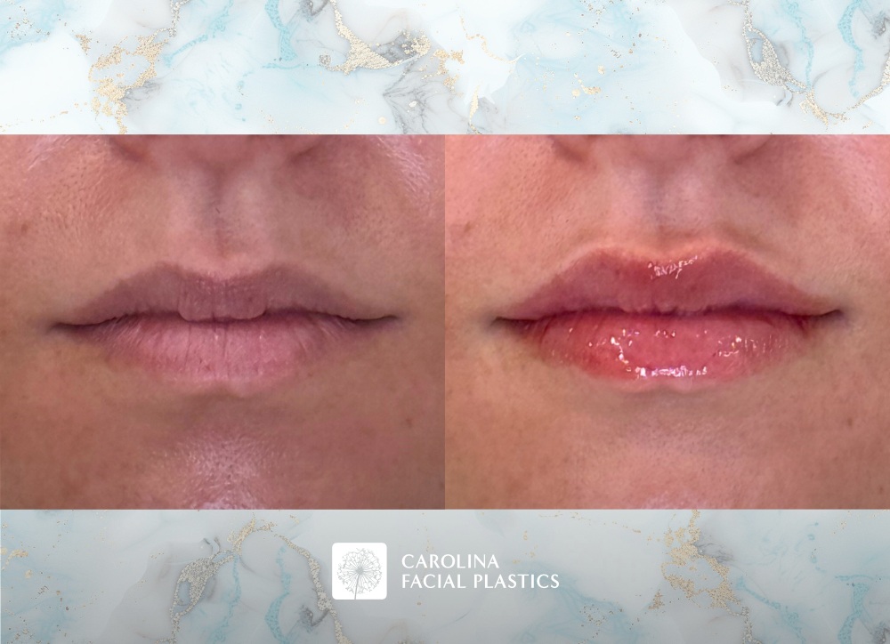 Lip filler before and after photos