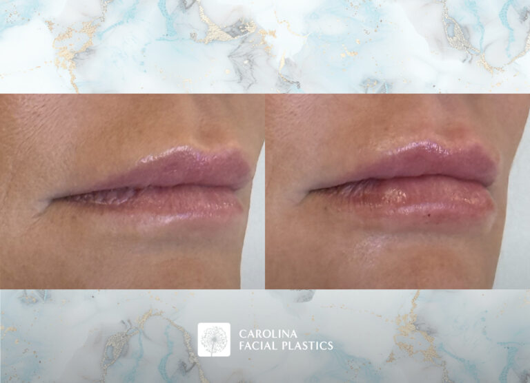 Lip filler before and after photos