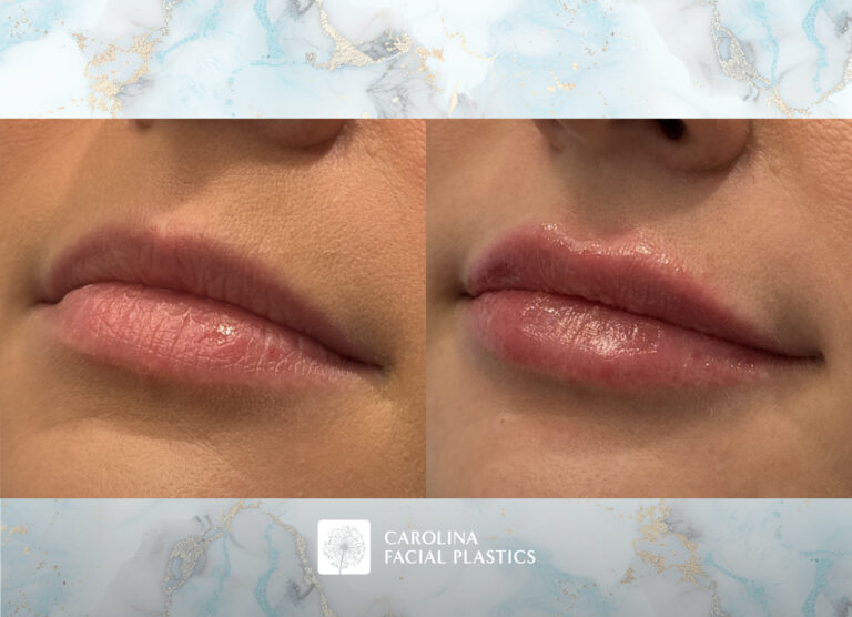 Lip filler before and after photos