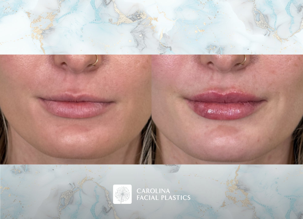 Lip filler before and after photos