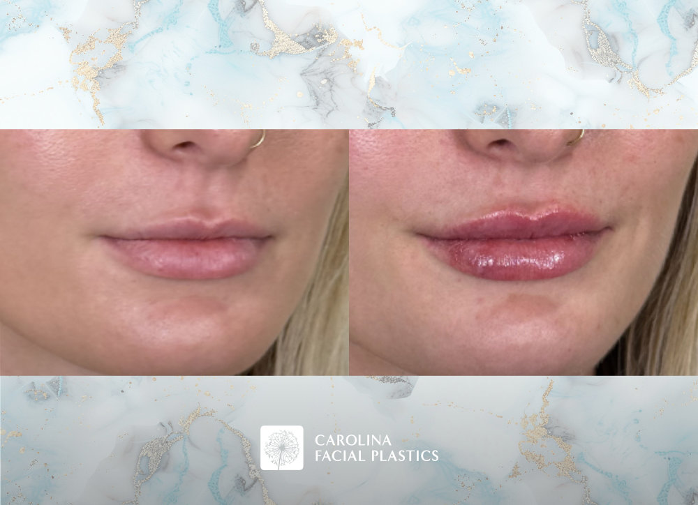 Lip filler before and after photos