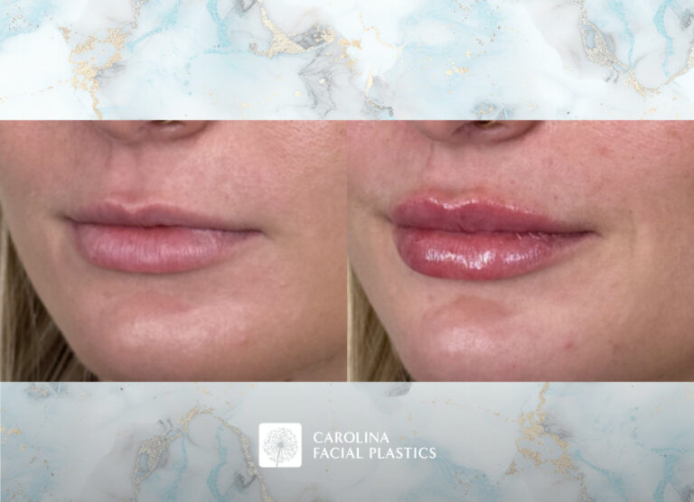 Lip filler before and after photos