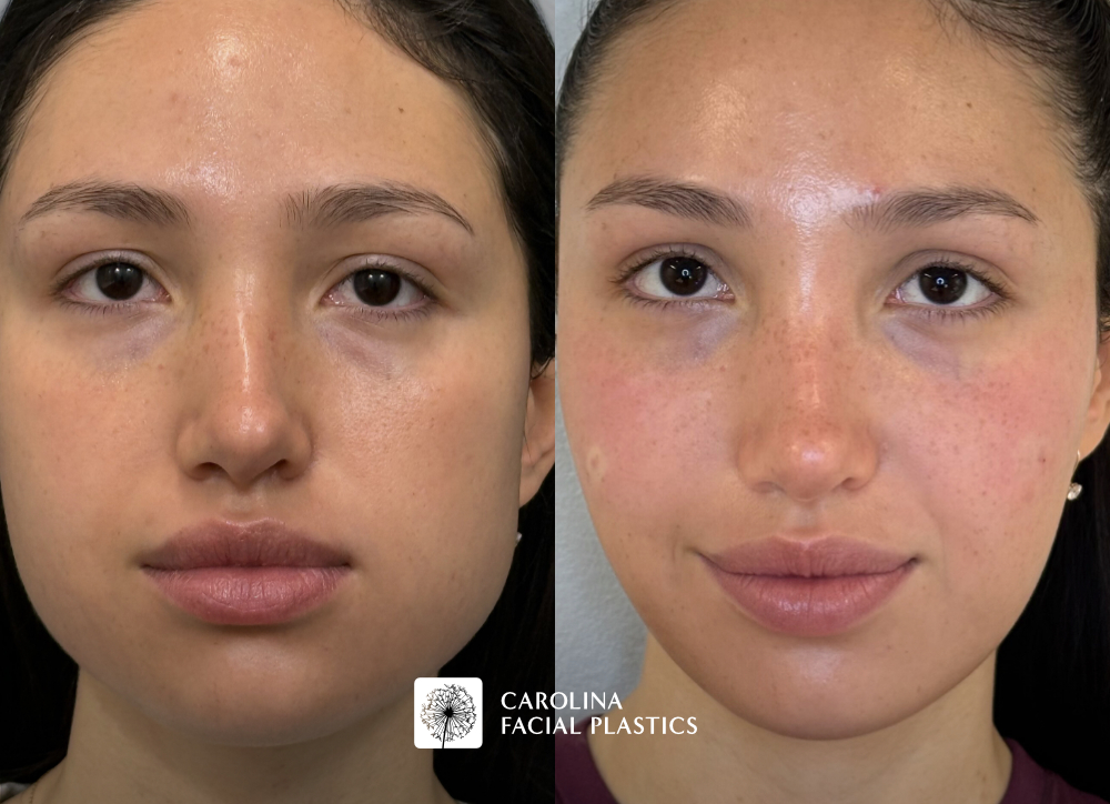 Before and after photos for masseter botox