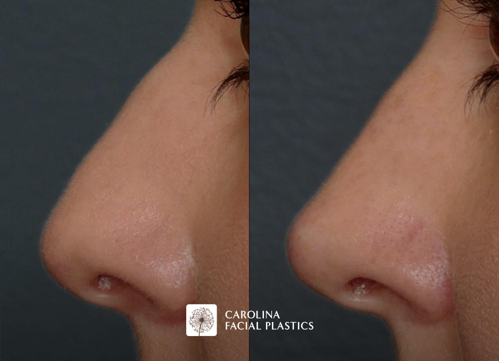 Non Surgical Rhinoplasty before and after photos