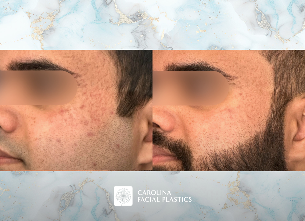 Before and after photos of microneedling