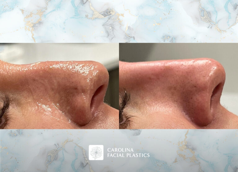Non Surgical Rhinoplasty before and after photos