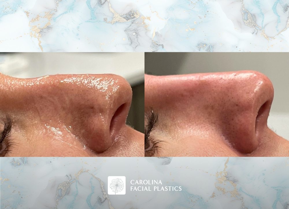 Non Surgical Rhinoplasty before and after photos